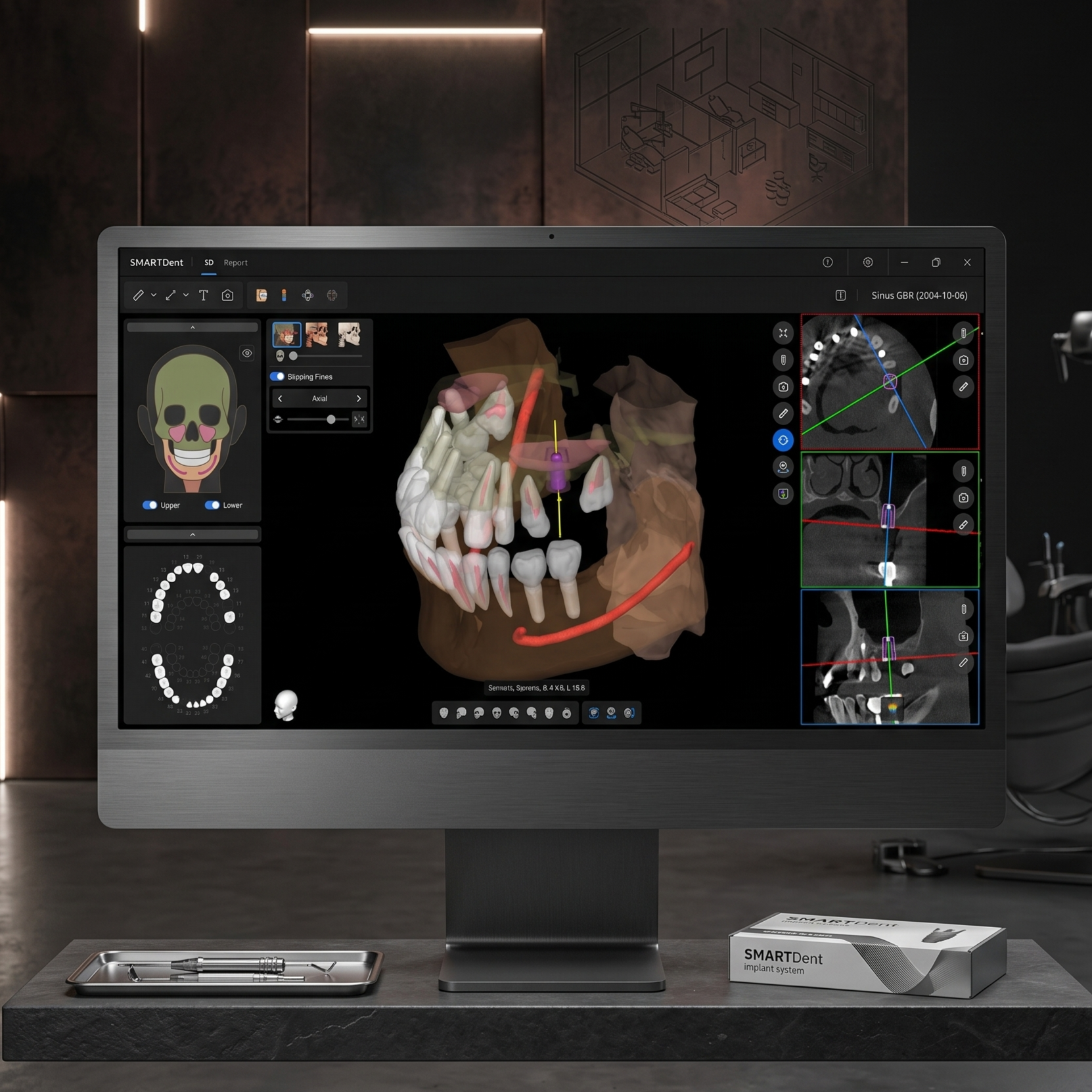 Virtual Simulation Implant — Ray 5D digital guided surgery system, Yonsei Severance Dental Seoul