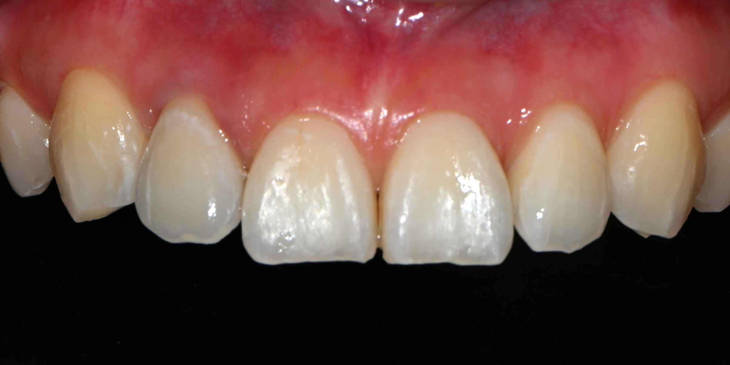 Conservative tooth treatment after — natural tooth preservation result, Yonsei Severance Dental