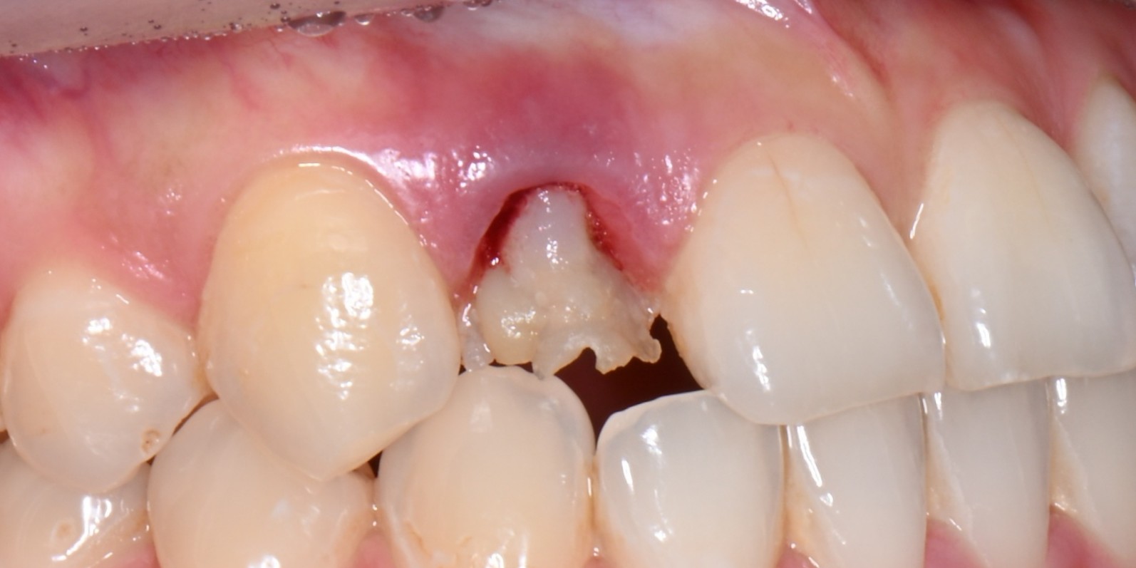 Conservative tooth treatment before — natural tooth preservation, Yonsei Severance Dental