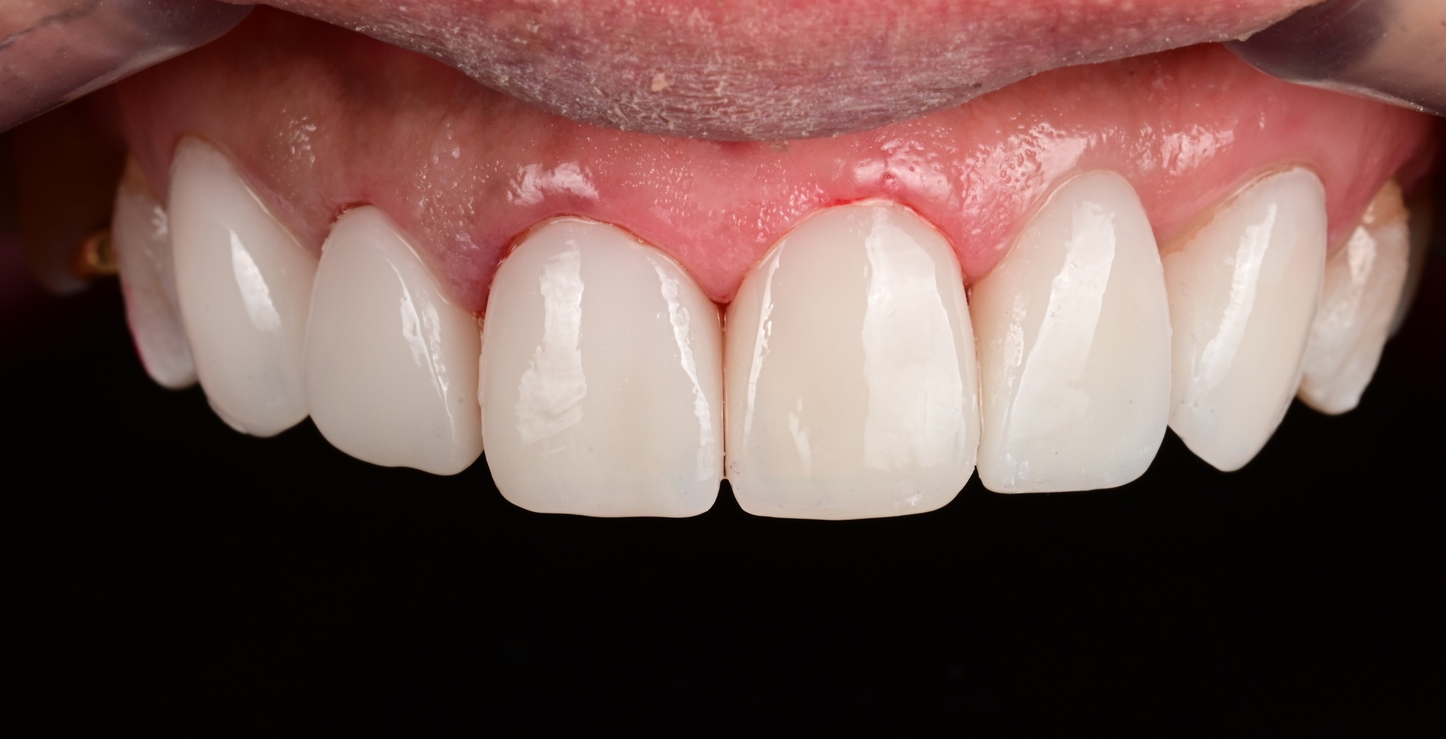 Aesthetic prosthetics after — ceramic laminate veneers result, Yonsei Severance Dental Seoul