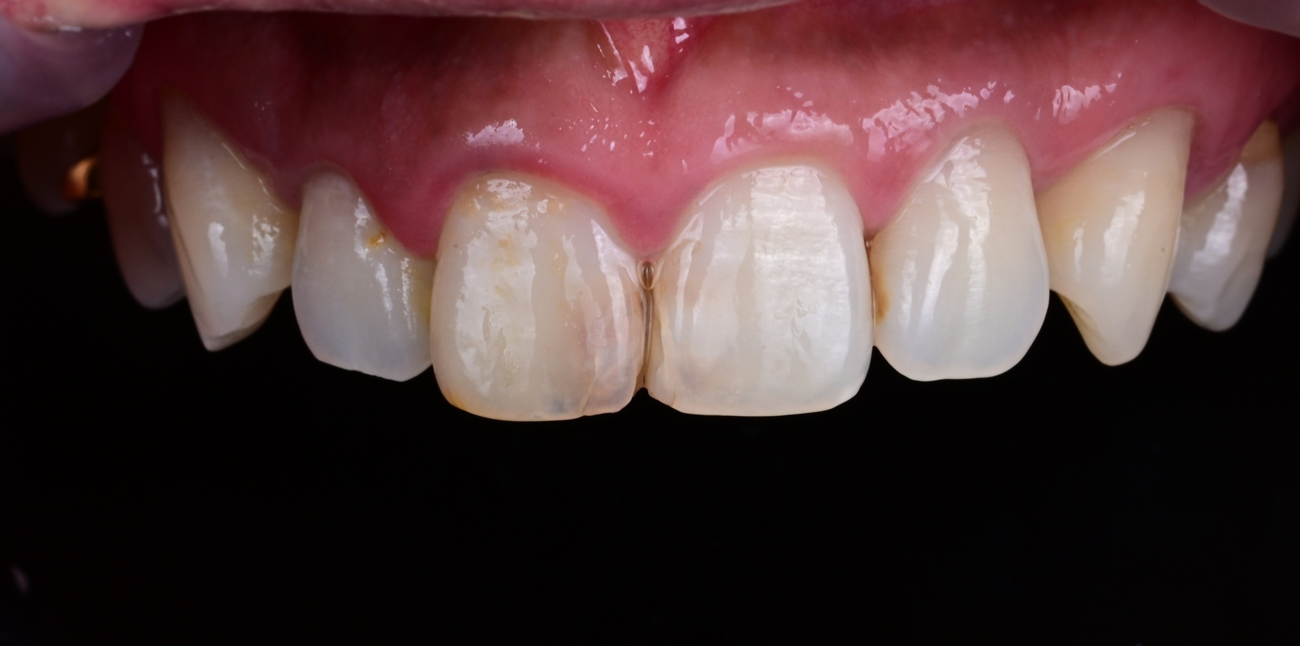 Aesthetic prosthetics before — ceramic laminate veneers, Yonsei Severance Dental Seoul